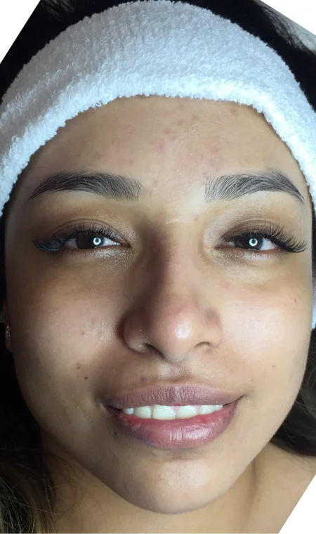 After Facial Deep Cleaning
