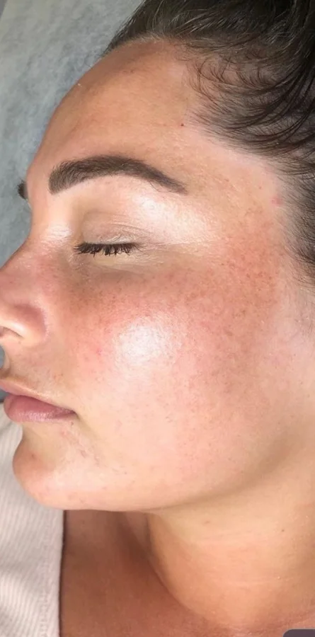 After Microneedling