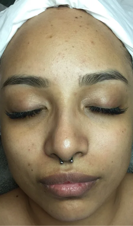 Before Facial Deep Cleaning