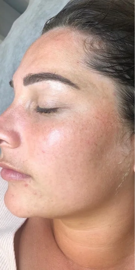 Before Microneedling