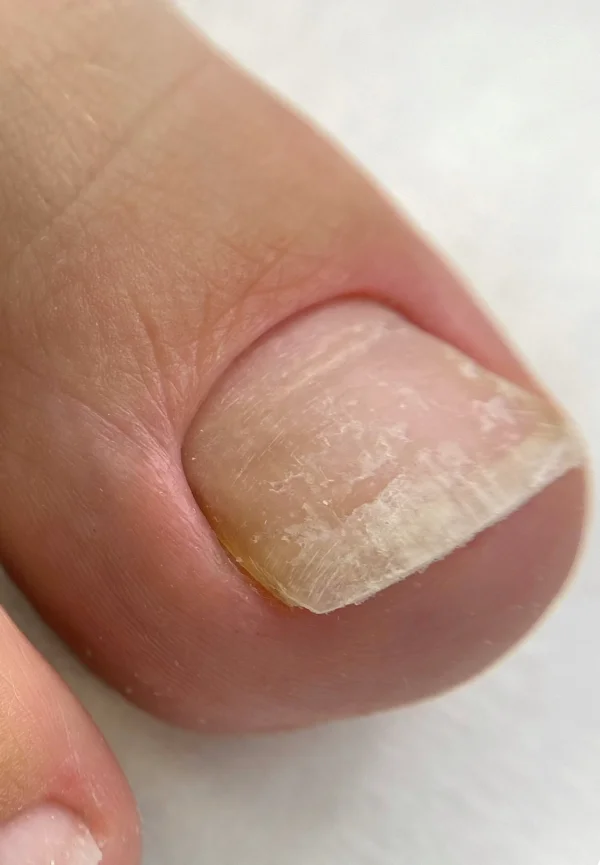 Before Pedicure